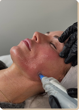 Microneedling