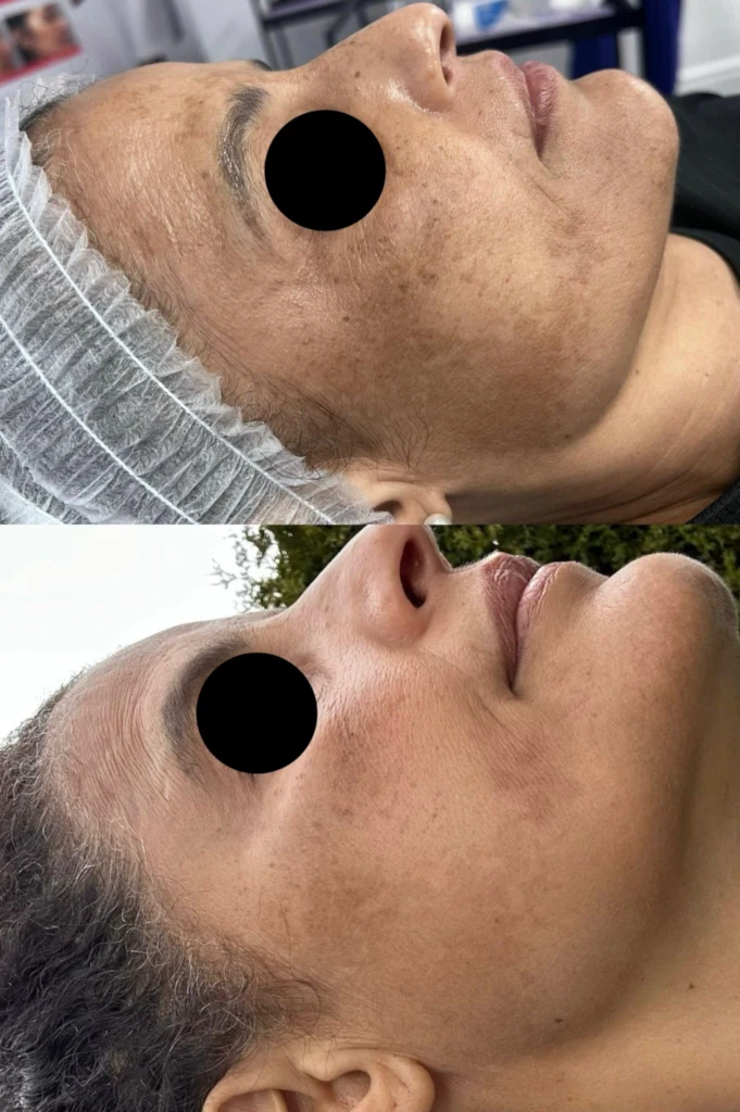 microchannilng before after22