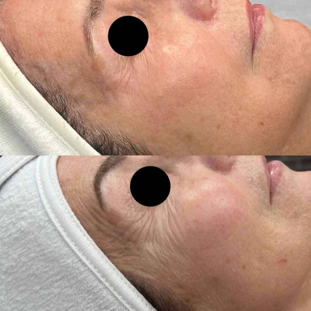 microchannilng before after23