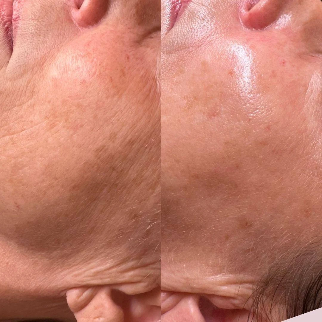 Microneedling-before-after (1)