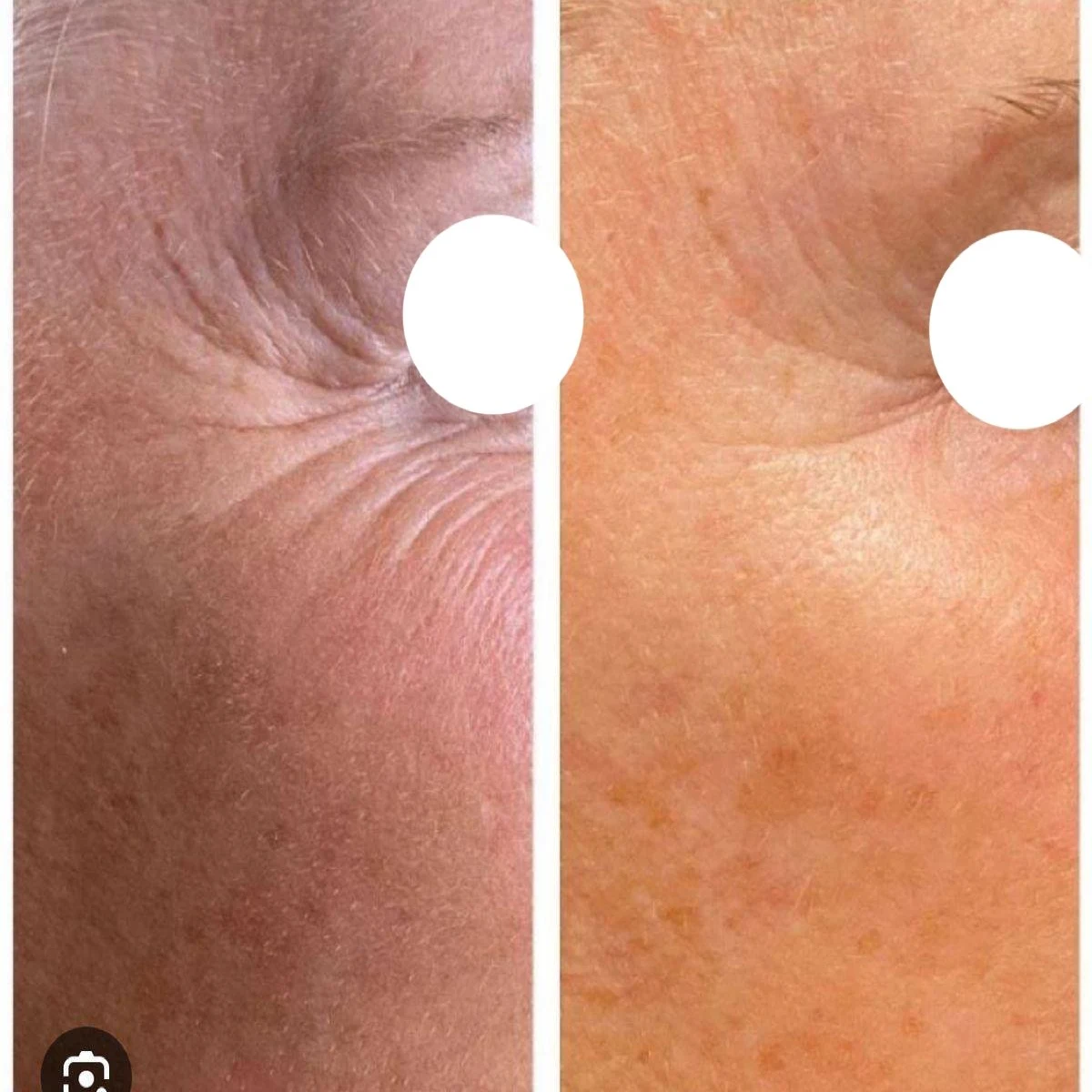 Microneedling-before-after (2)