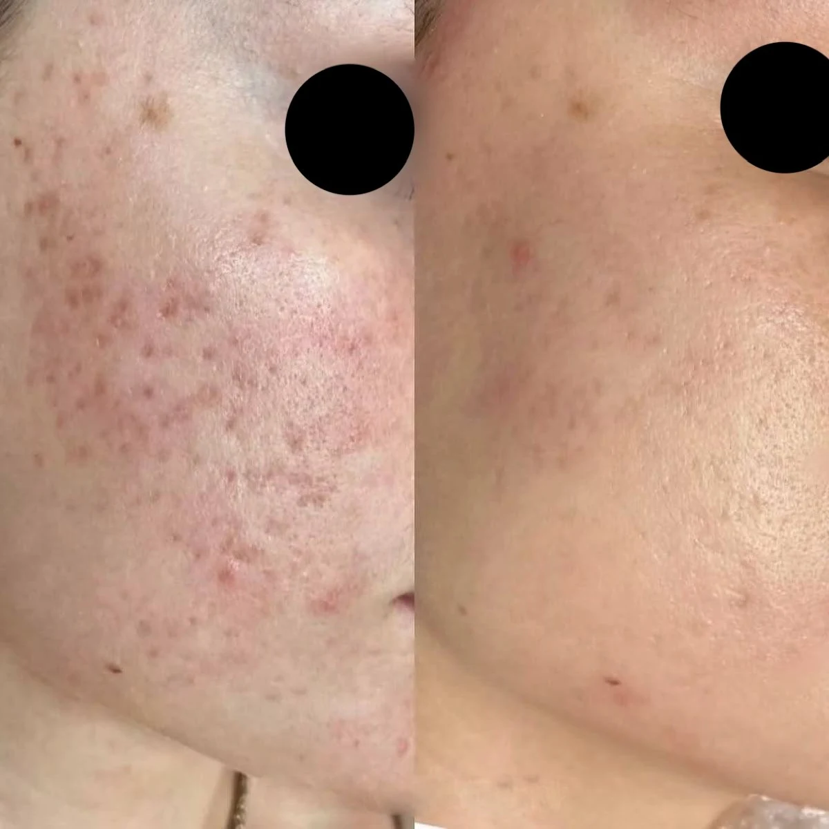 Microneedling-before-after (3)