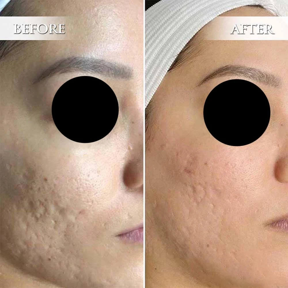 Microneedling-before-after (4)