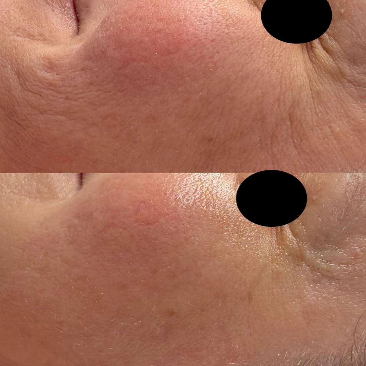 Microneedling-before-after (5)