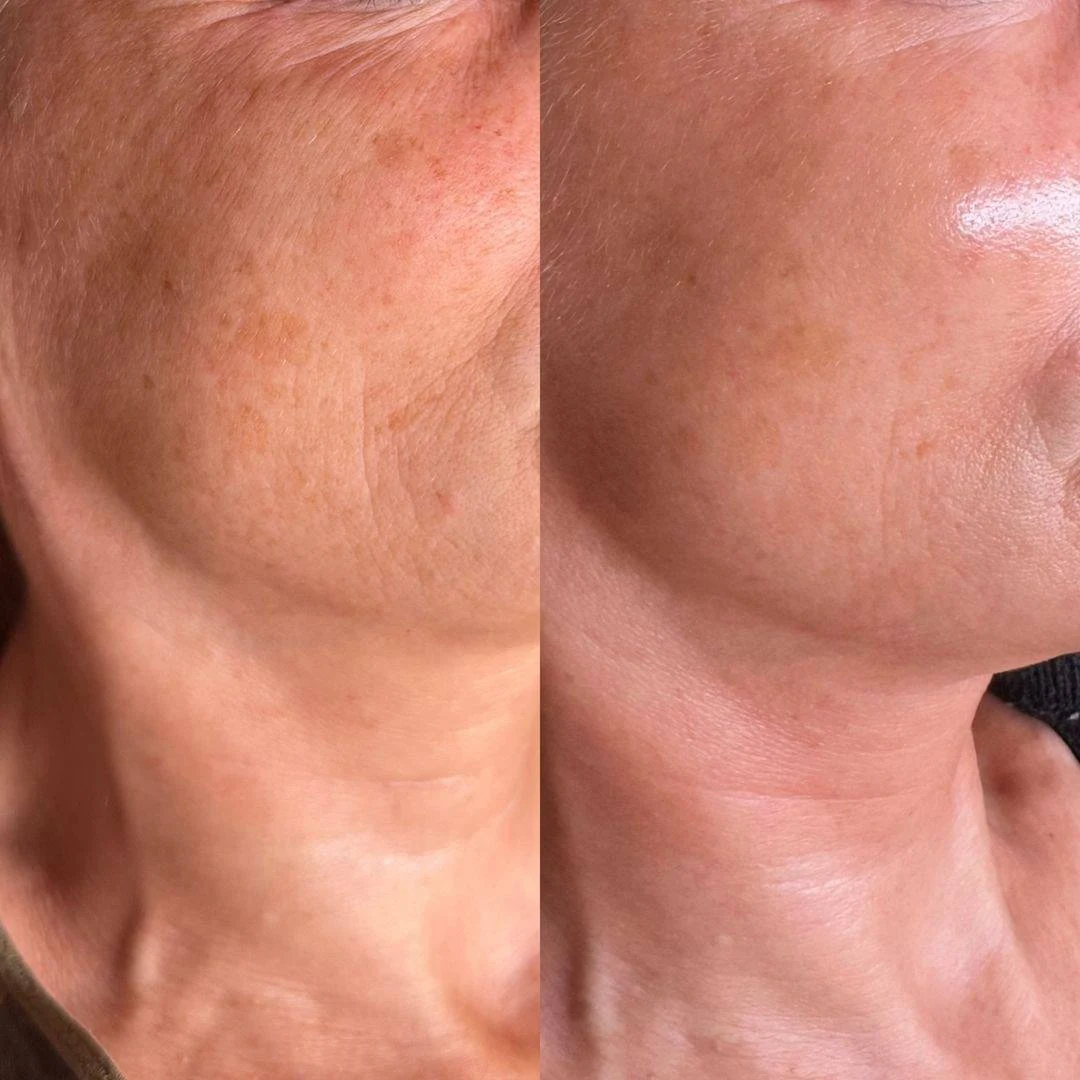 Microneedling-before-after