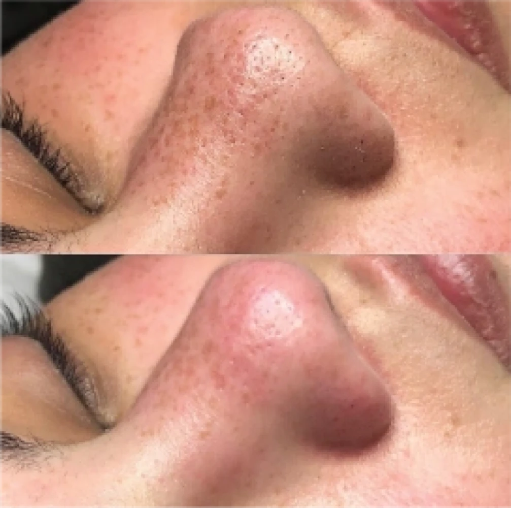Hydro-before-after4