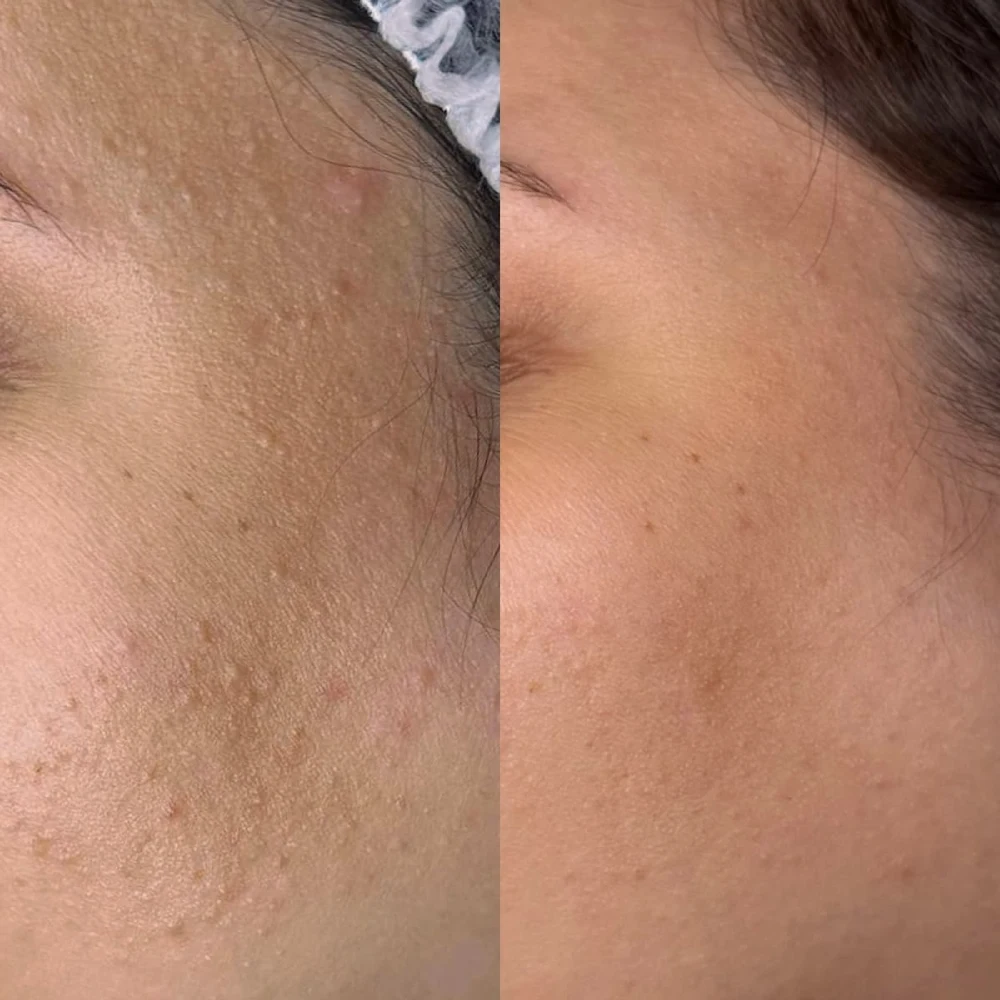 before-after-chemical-peels (1)