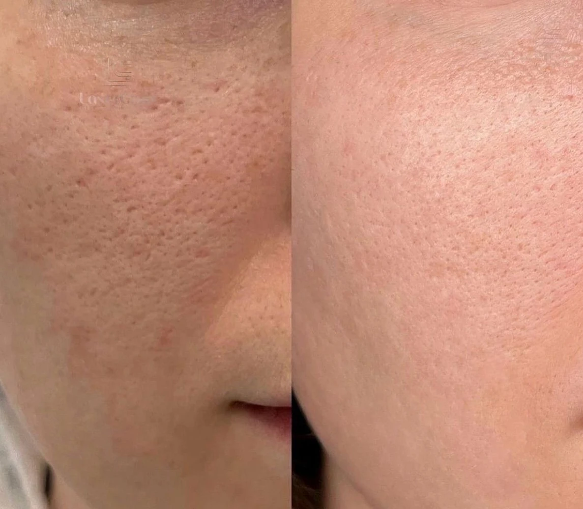 before-after-chemical-peels (2)