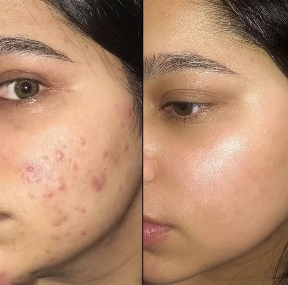 before-after-chemical-peels (3)