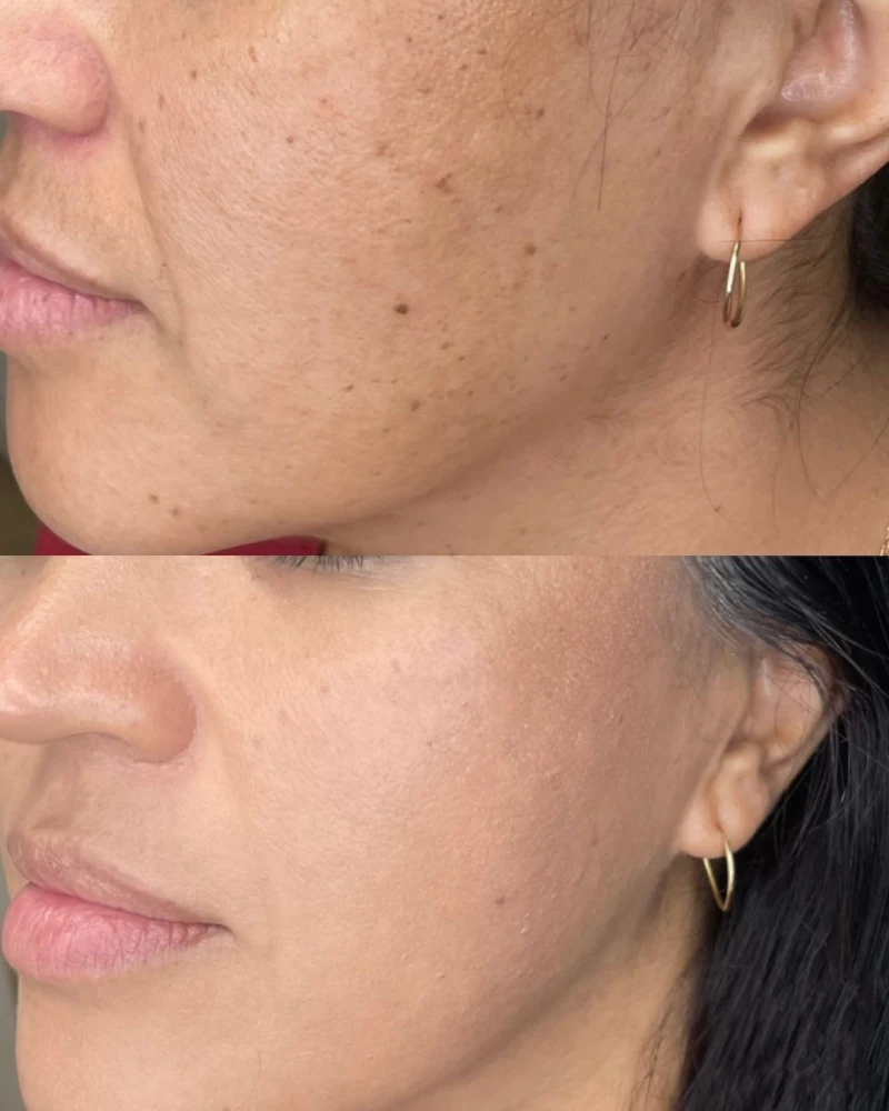 before-after-chemical-peels (4)