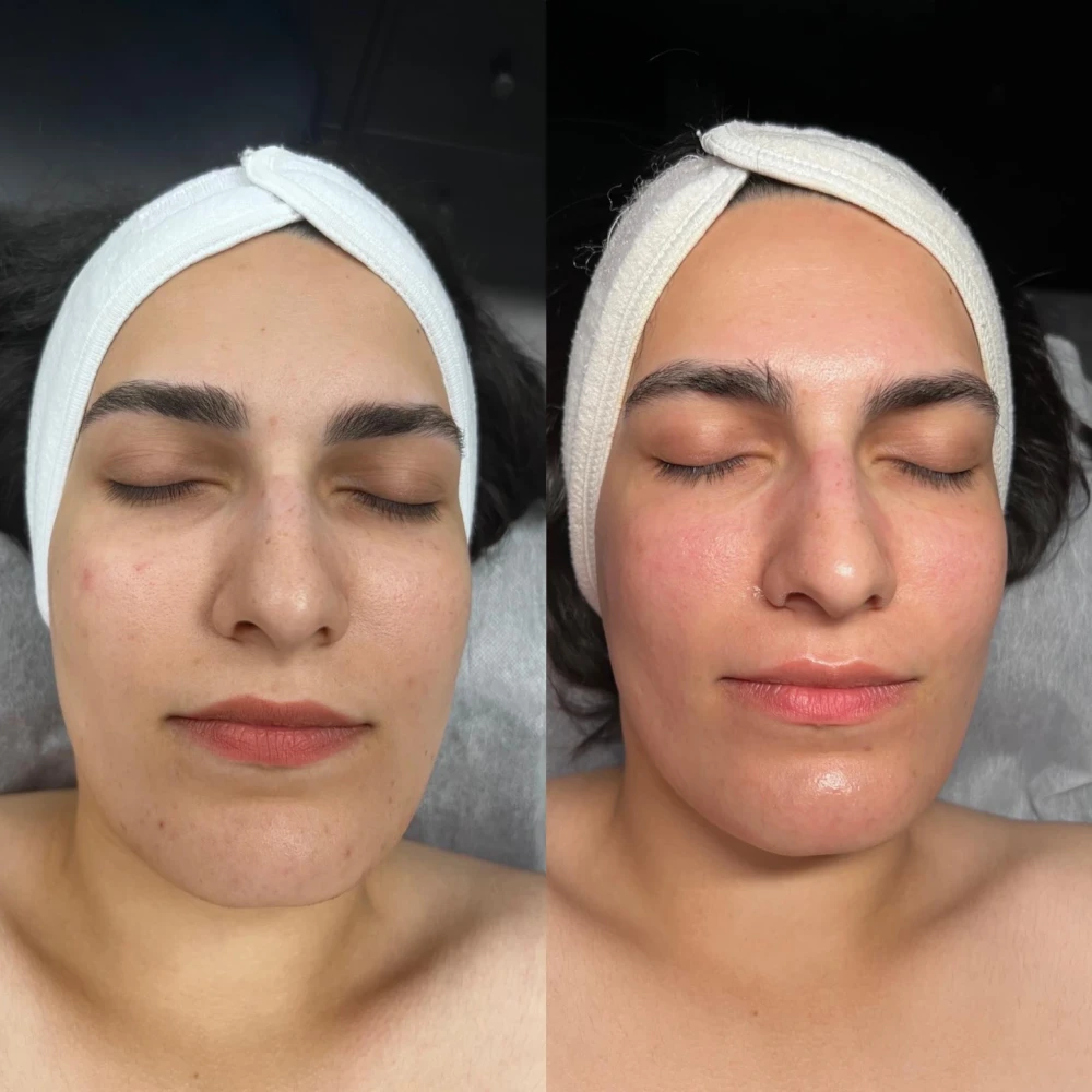 before-after-chemical-peels