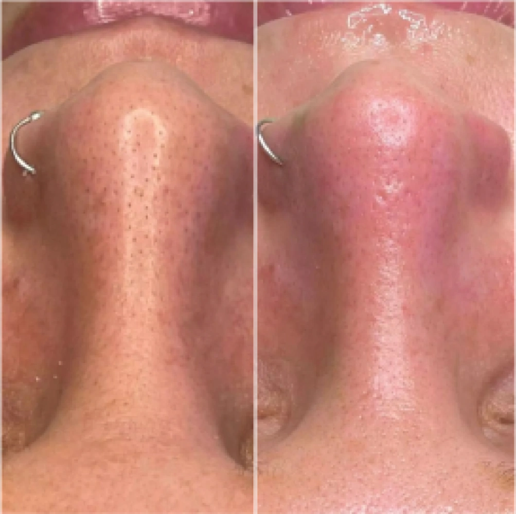 hydro-before-after (1)