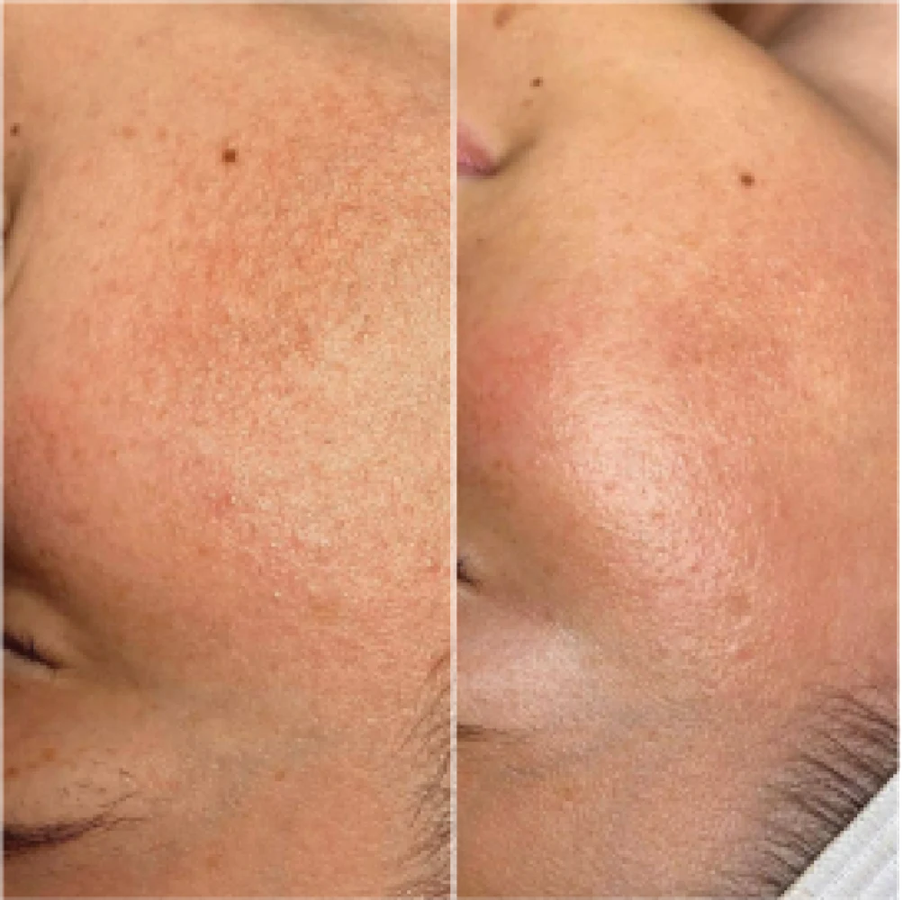 hydro-before-after (2)
