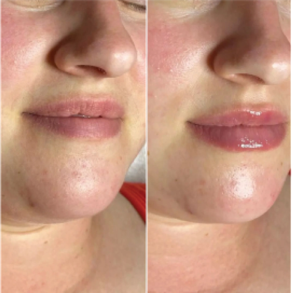 hydro-before-after (3)