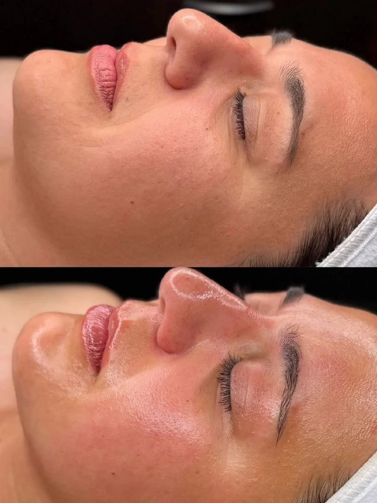 hydro-before-after