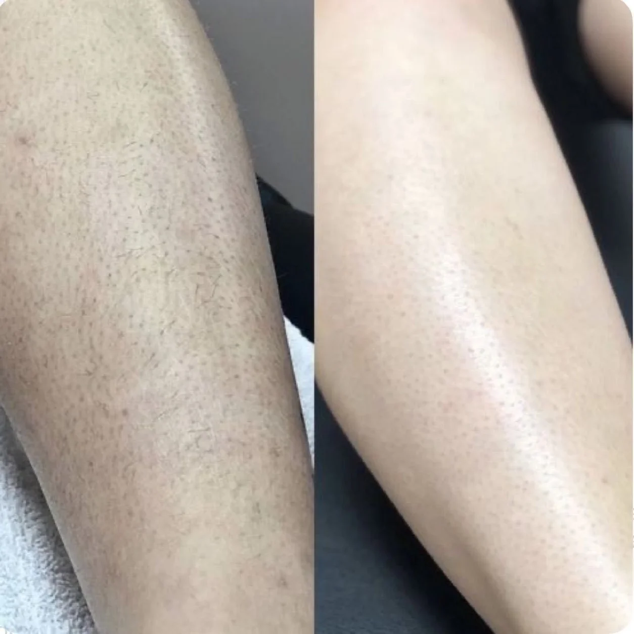 laser before after new (1)