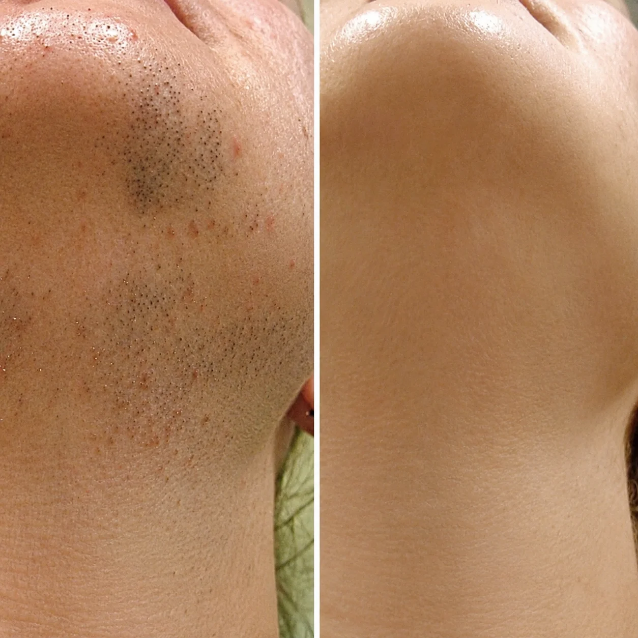 laser before after new (2)