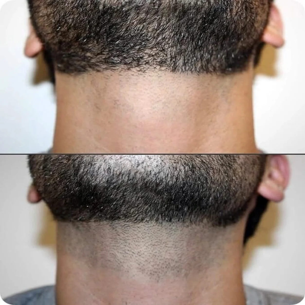 laser before after new