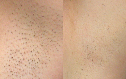 laser hair removal before after (1)