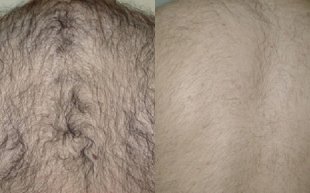 laser hair removal before after