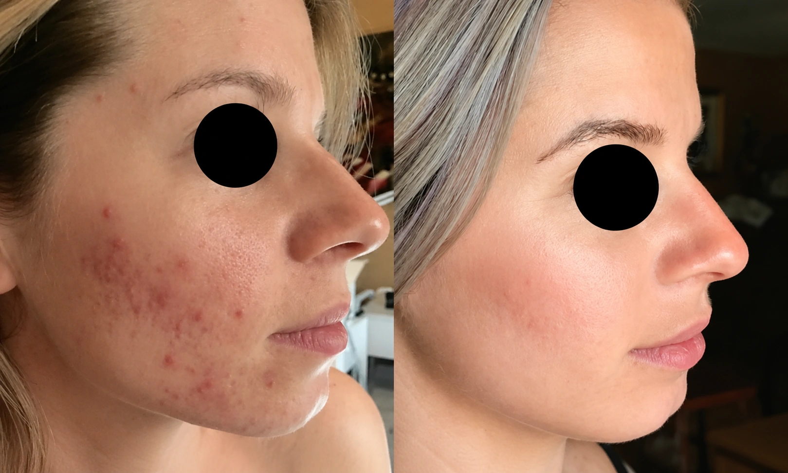microchanneling-before after 3