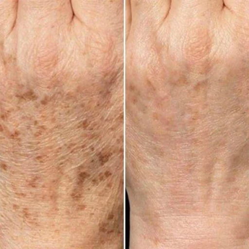 non ab laser before after (1)