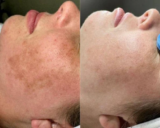 non ab laser before after (2)