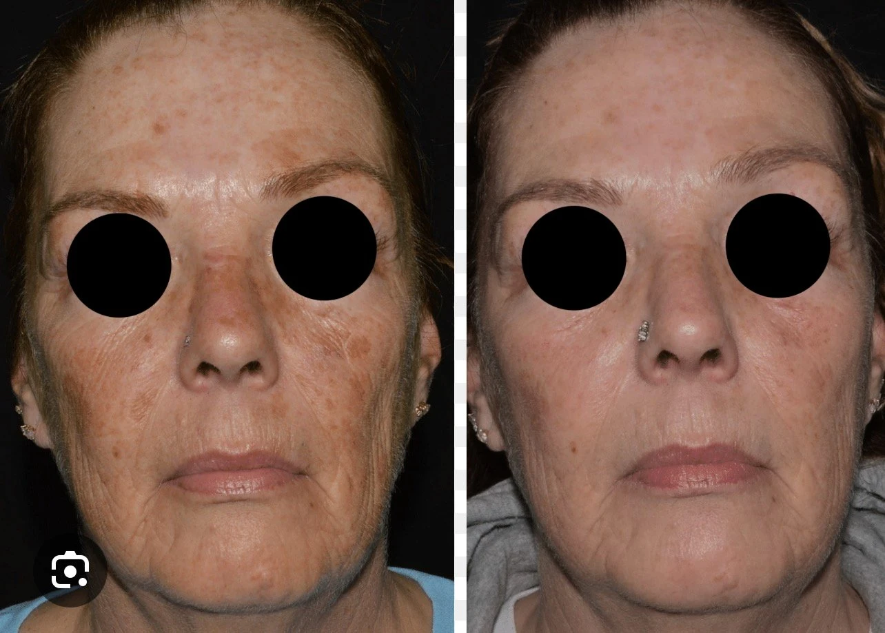 non ab laser before after 23 (1)