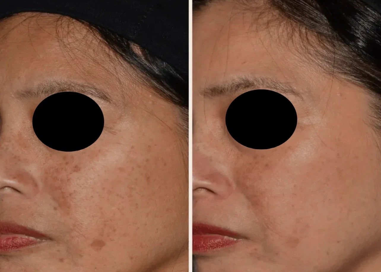 non ab laser before after 23