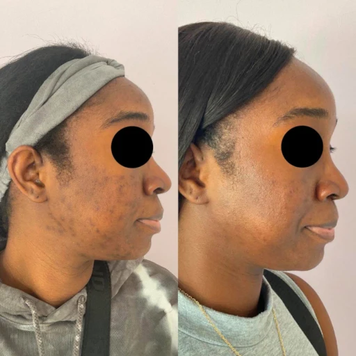 non ab laser before after (3)