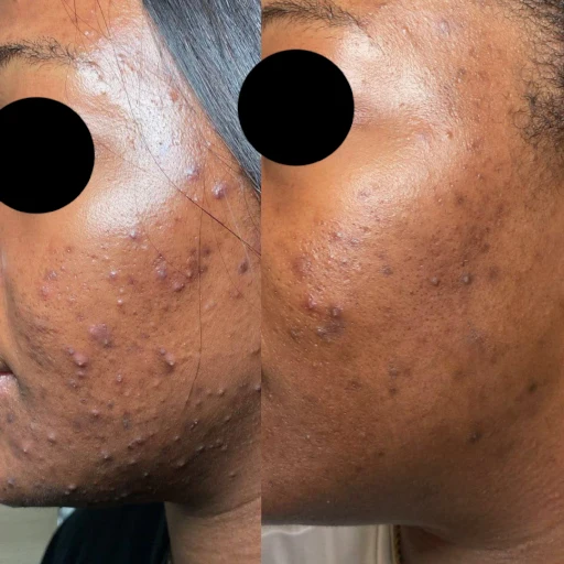 non ab laser before after (4)
