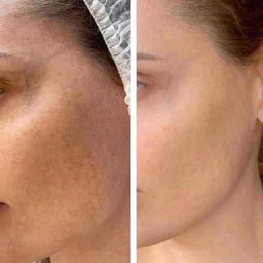 non ab laser before after
