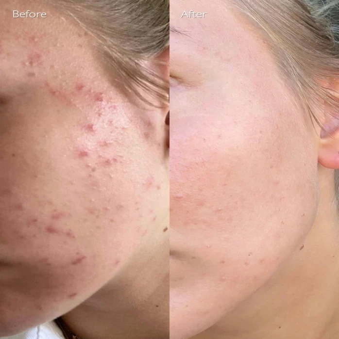non ab laser before after41 (1)