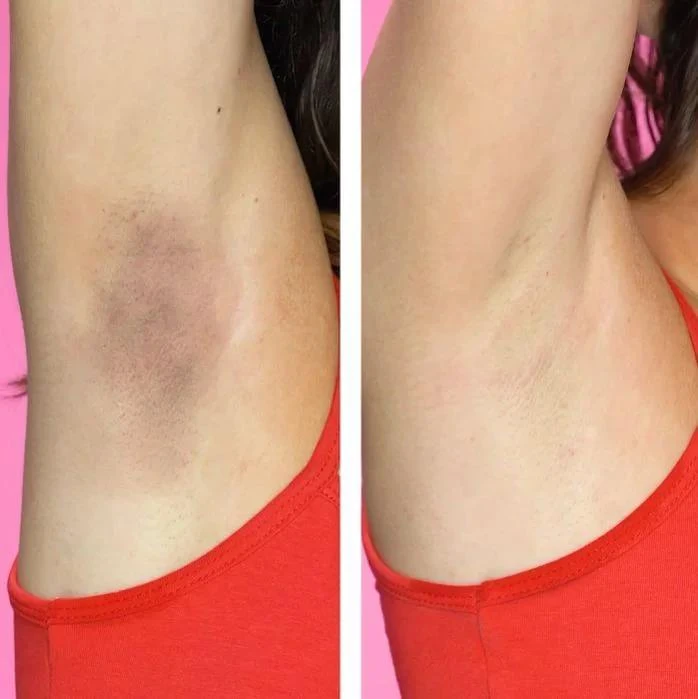 non ab laser before after41 (2)