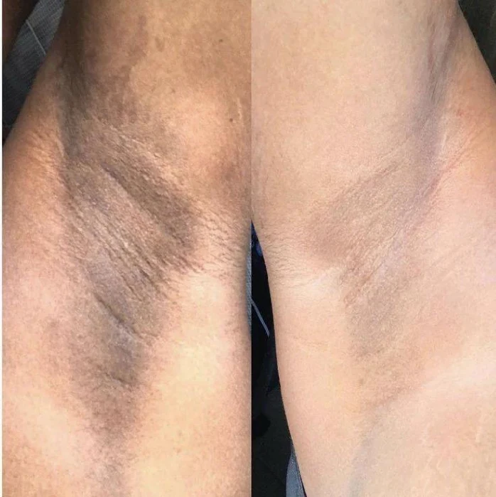non ab laser before after41
