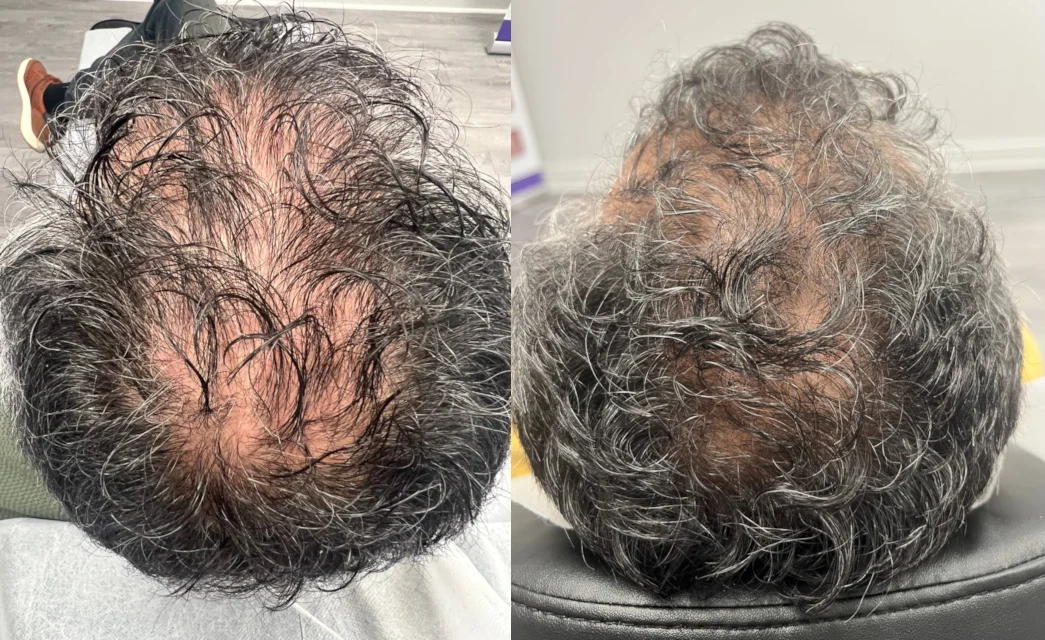 Hair growth before after